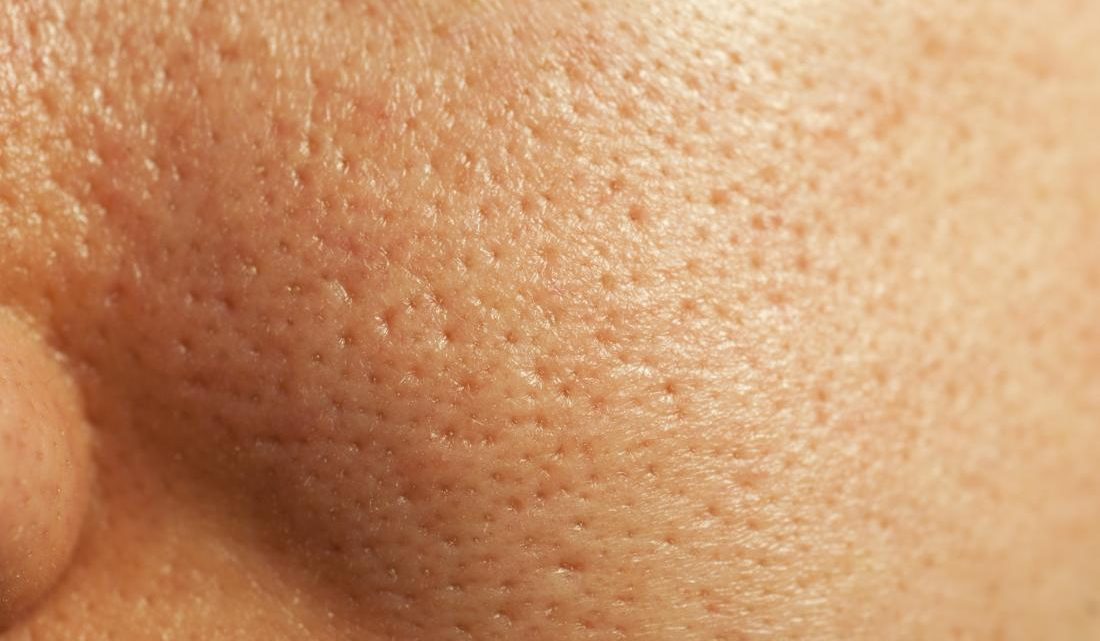 Tired of Large Pores? Here’s How to Make them Smaller